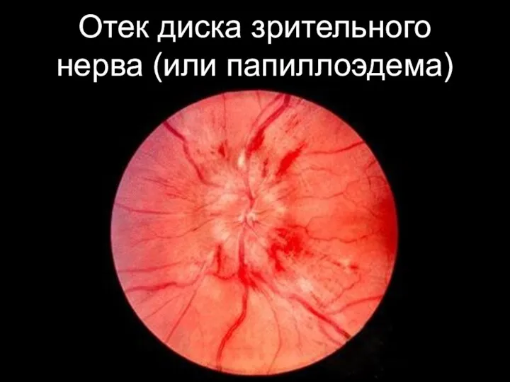 Отек диска зрительного нерва (или папиллоэдема)
