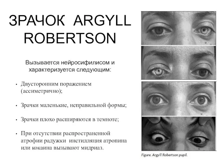 ЗРАЧОК ARGYLL ROBERTSON Вызывается нейросифилисом и характеризуется следующим: Двусторонним поражением