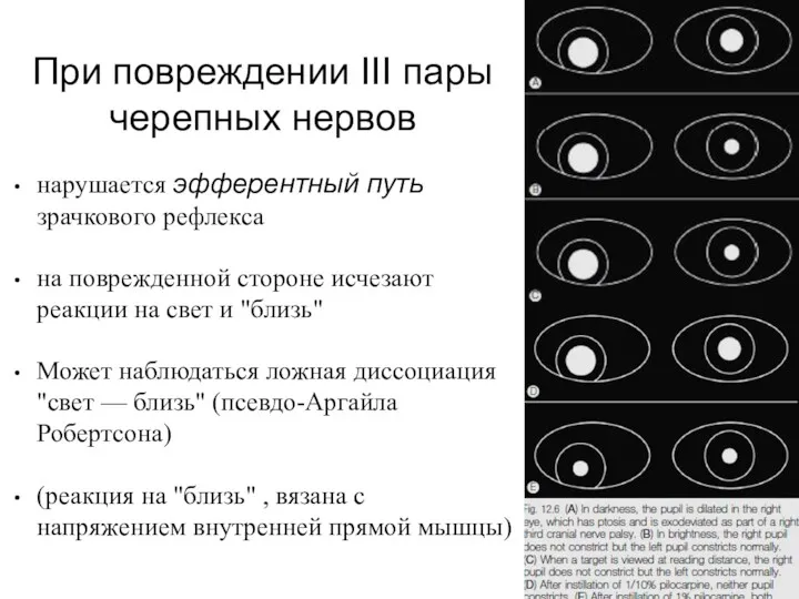 При повреждении III пары черепных нервов нарушается эфферентный путь зрачкового