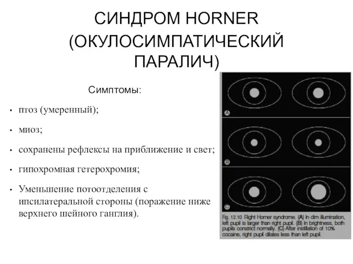 СИНДРОМ HORNER (ОКУЛОСИМПАТИЧЕСКИЙ ПАРАЛИЧ) Симптомы: птоз (умеренный); миоз;с сохранены рефлексы