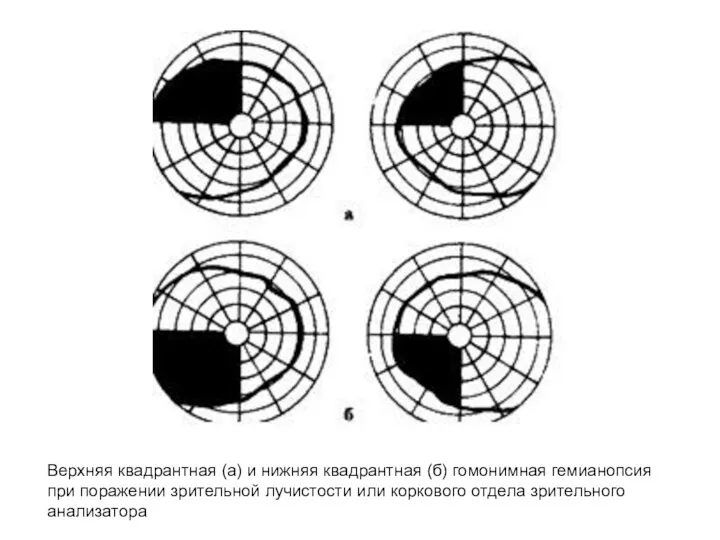 Верхняя квадрантная (а) и нижняя квадрантная (б) гомонимная гемианопсия при поражении зрительной лучистости