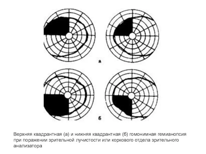 Верхняя квадрантная (а) и нижняя квадрантная (б) гомонимная гемианопсия при