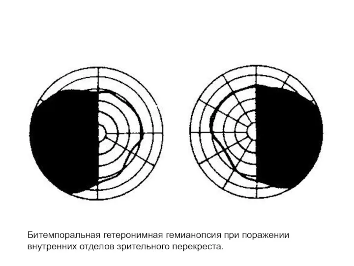 Битемпоральная гетеронимная гемианопсия при поражении внутренних отделов зрительного перекреста.