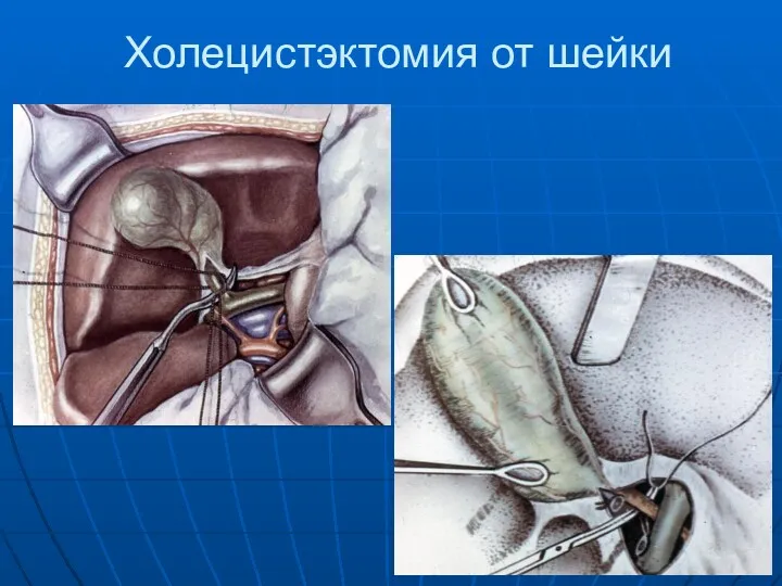 Холецистэктомия от шейки