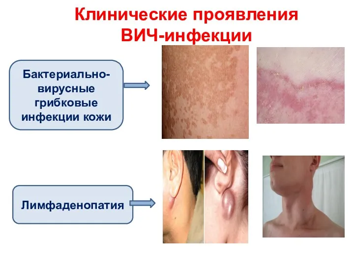 Клинические проявления ВИЧ-инфекции Бактериально-вирусные грибковые инфекции кожи Лимфаденопатия