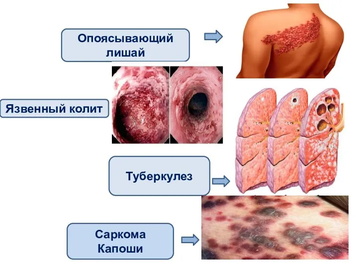 Опоясывающий лишай Язвенный колит Туберкулез Саркома Капоши