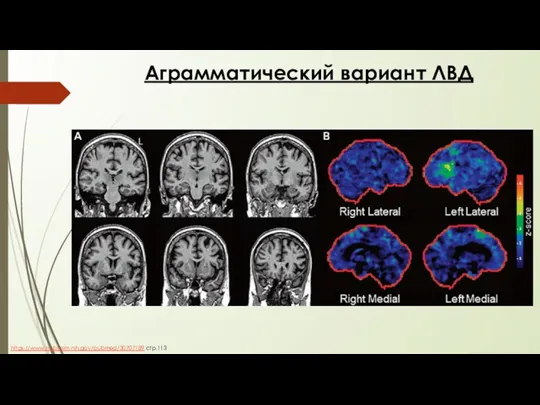 Аграмматический вариант ЛВД https://www.ncbi.nlm.nih.gov/pubmed/30707189 стр.113