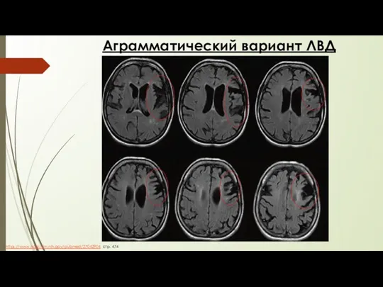 Аграмматический вариант ЛВД https://www.ncbi.nlm.nih.gov/pubmed/27042904 стр. 474