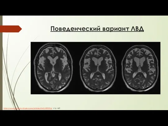 Поведенческий вариант ЛВД https://www.ncbi.nlm.nih.gov/pmc/articles/PMC5390934/ стр. 469