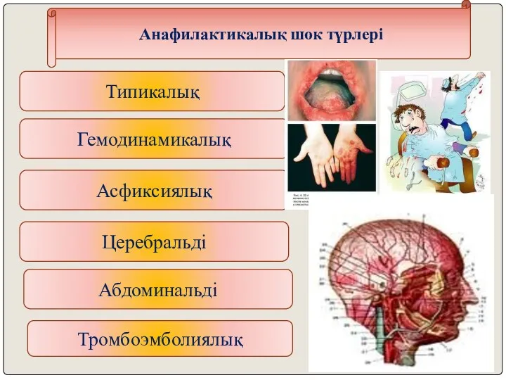 Анафилактикалық шок түрлері Типикалық Гемодинамикалық Асфиксиялық Церебральді Тромбоэмболиялық Абдоминальді