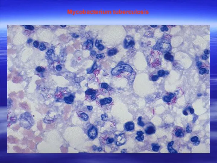 Mycobacterium tuberculosis