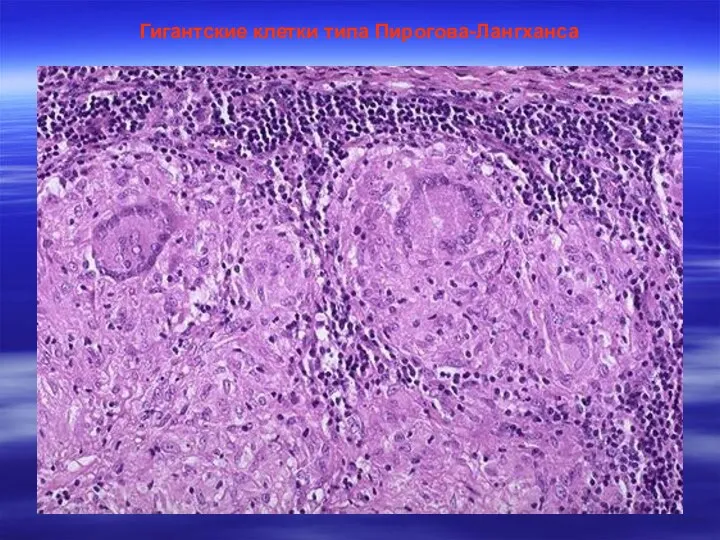 Гигантские клетки типа Пирогова-Лангханса