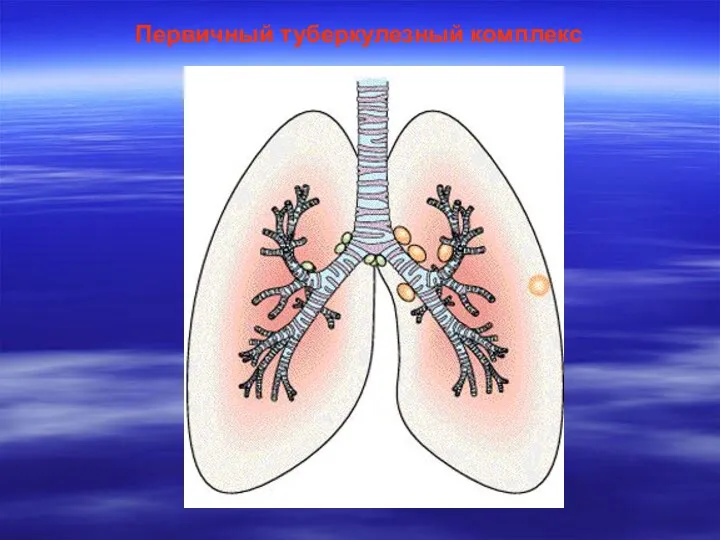 Первичный туберкулезный комплекс