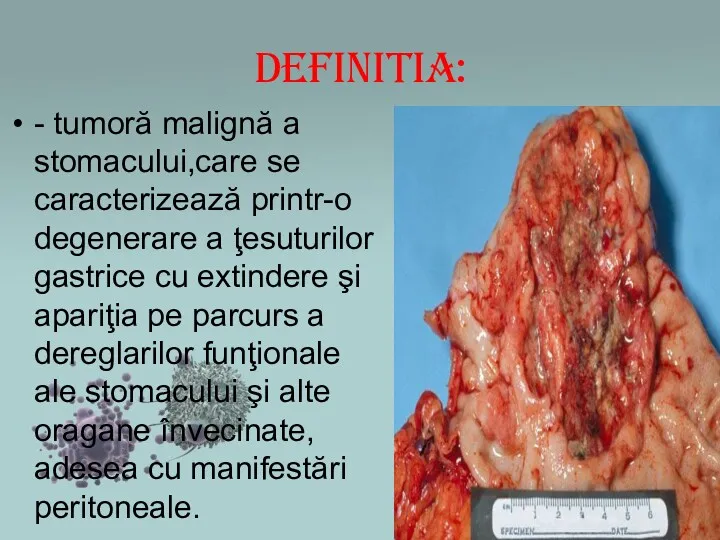 DefiniTia: - tumoră malignă a stomacului,care se caracterizează printr-o degenerare