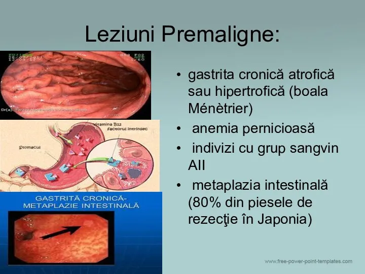 Leziuni Premaligne: gastrita cronică atrofică sau hipertrofică (boala Ménètrier) anemia