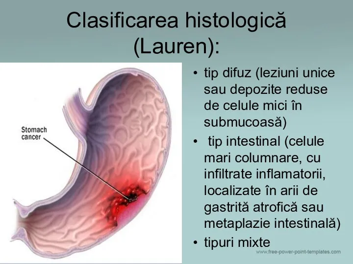 Clasificarea histologică (Lauren): tip difuz (leziuni unice sau depozite reduse