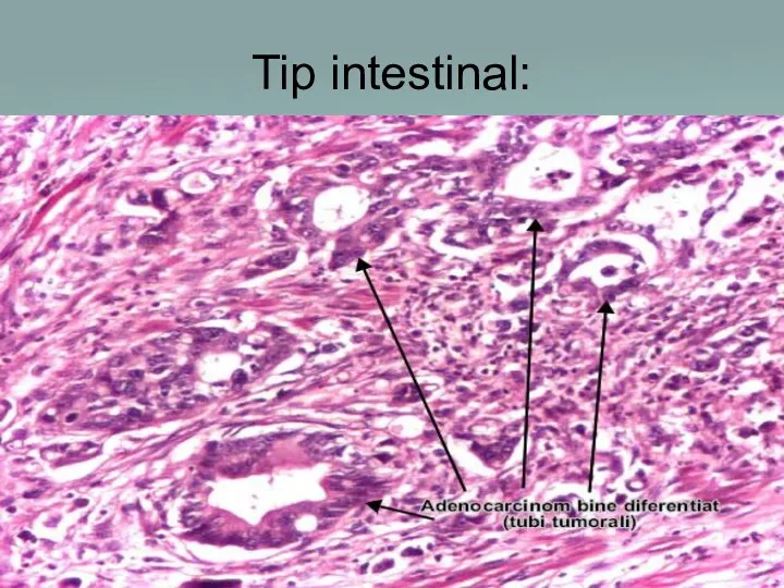 Tip intestinal: