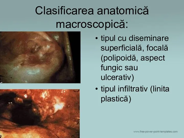 Clasificarea anatomică macroscopică: tipul cu diseminare superficială, focală (polipoidă, aspect