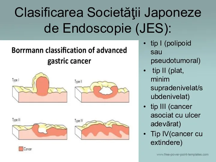 Clasificarea Societăţii Japoneze de Endoscopie (JES): tip I (polipoid sau