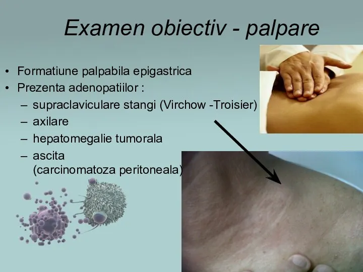 Examen obiectiv - palpare Formatiune palpabila epigastrica Prezenta adenopatiilor :