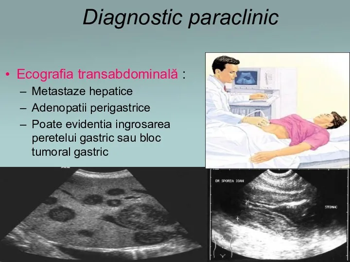 Diagnostic paraclinic Ecografia transabdominală : Metastaze hepatice Adenopatii perigastrice Poate