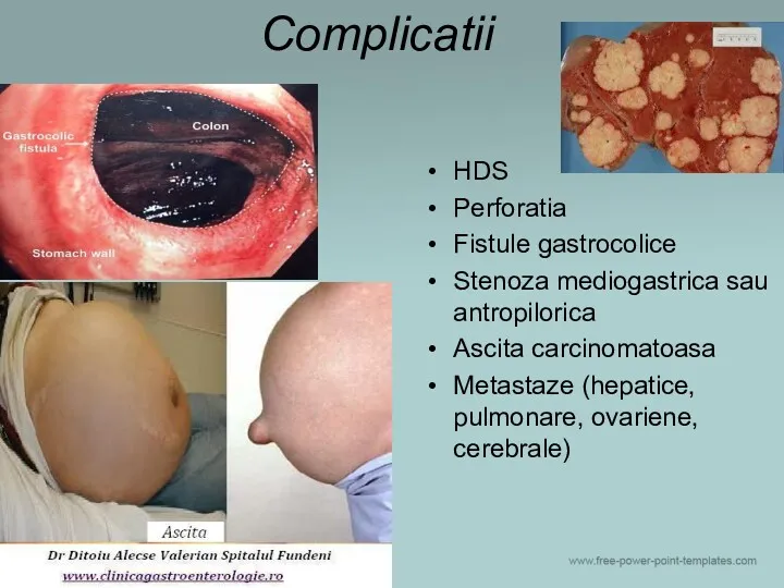 Complicatii HDS Perforatia Fistule gastrocolice Stenoza mediogastrica sau antropilorica Ascita carcinomatoasa Metastaze (hepatice, pulmonare, ovariene, cerebrale)