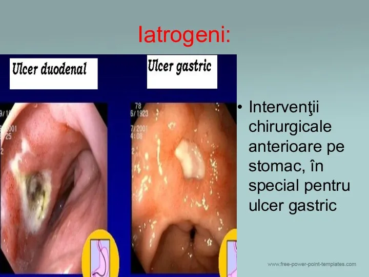 Iatrogeni: Intervenţii chirurgicale anterioare pe stomac, în special pentru ulcer gastric