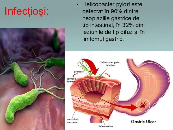 Infecțioși: Helicobacter pylori este detectat în 90% dintre neoplaziile gastrice