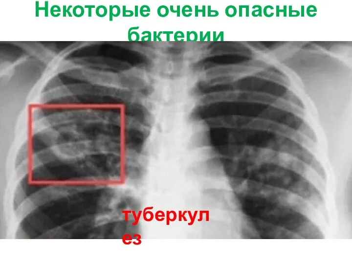 Некоторые очень опасные бактерии Бубонная чума туберкулез