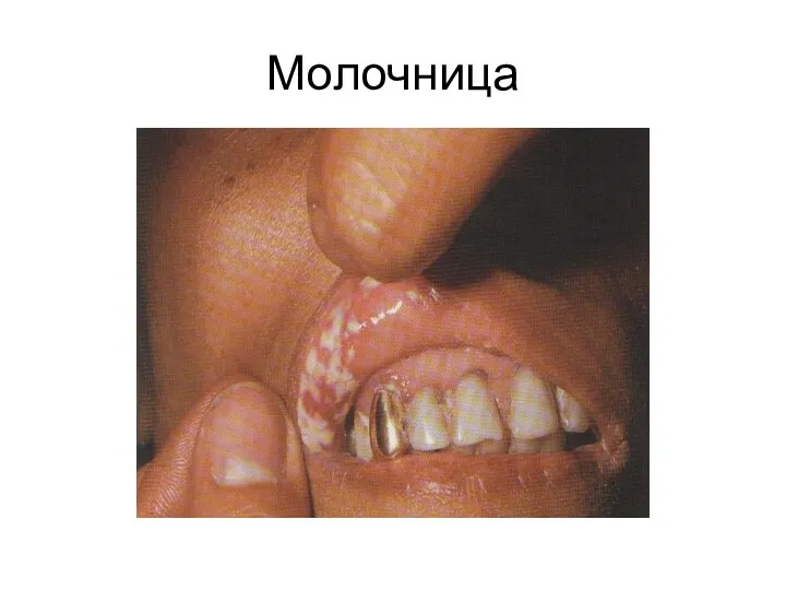 Молочница