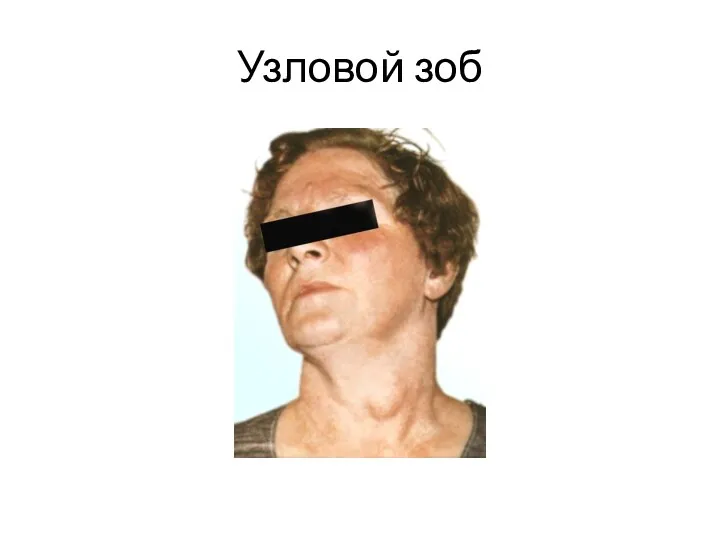 Узловой зоб