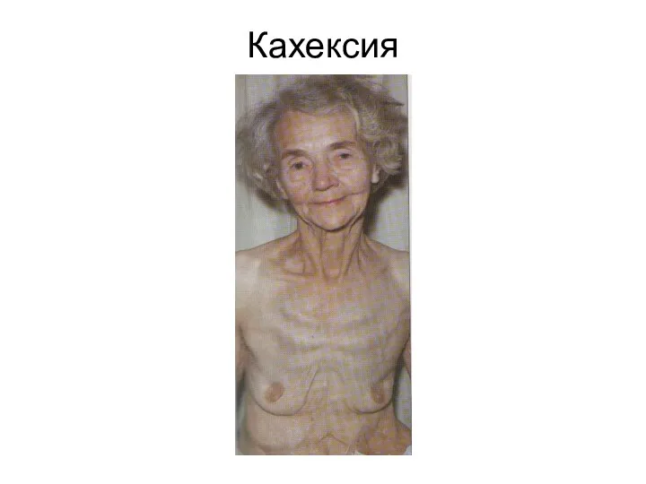 Кахексия