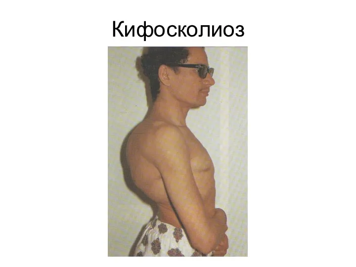 Кифосколиоз