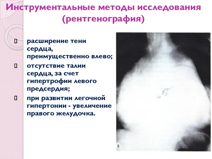 Инструментальные методы исследования (рентгенография) расширение тени сердца, преимущественно влево; отсутствие талии сердца, за