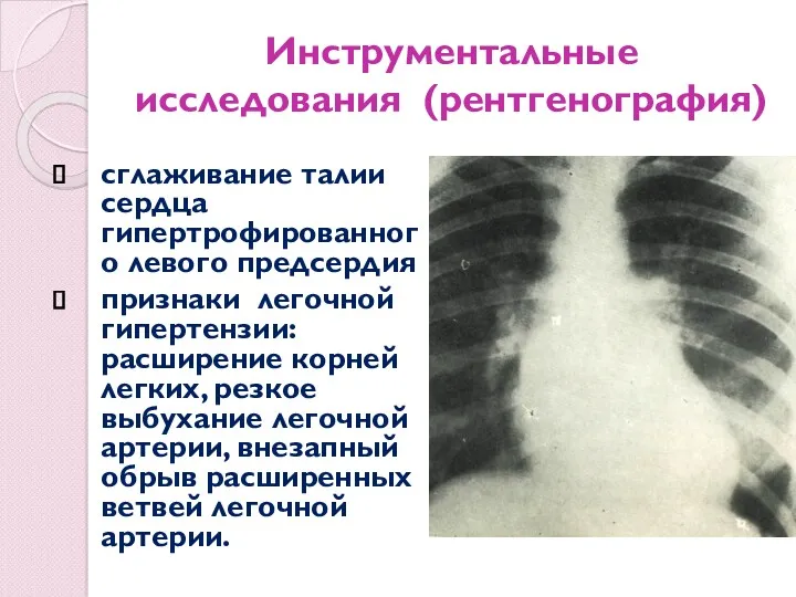 Инструментальные исследования (рентгенография) сглаживание талии сердца гипертрофированного левого предсердия признаки легочной гипертензии: расширение