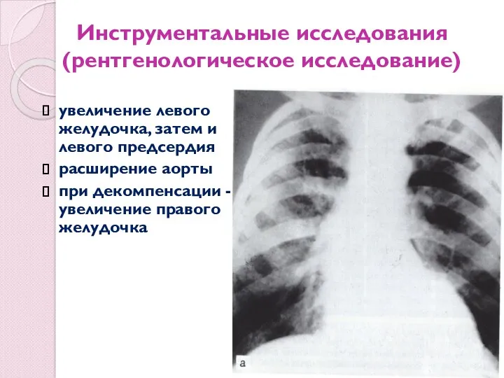 Инструментальные исследования (рентгенологическое исследование) увеличение левого желудочка, затем и левого предсердия расширение аорты