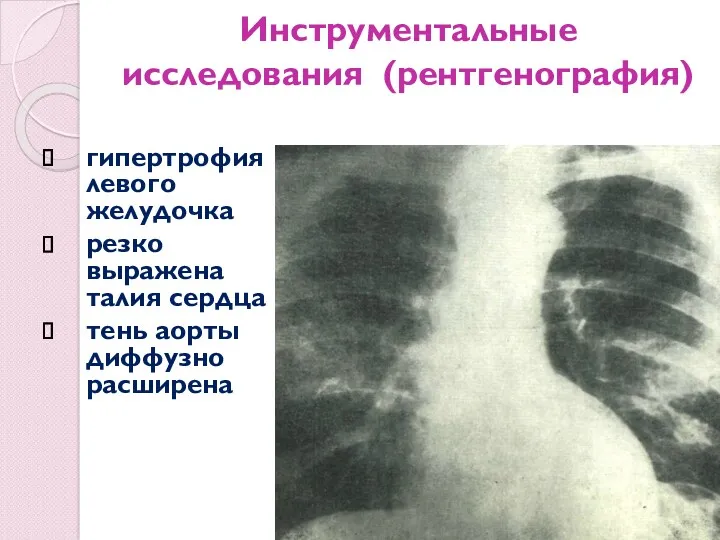 Инструментальные исследования (рентгенография) гипертрофия левого желудочка резко выражена талия сердца тень аорты диффузно расширена