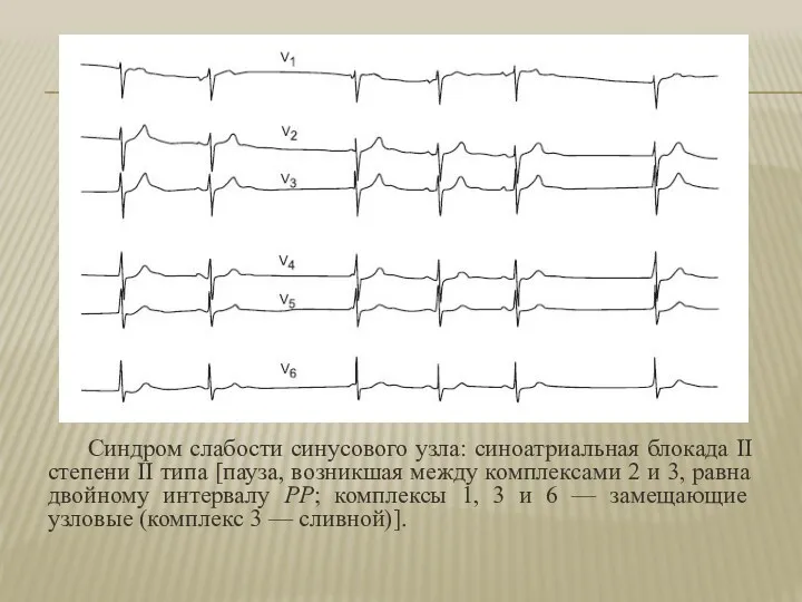 Синдром слабости синусового узла: синоатриальная блокада II степени II типа