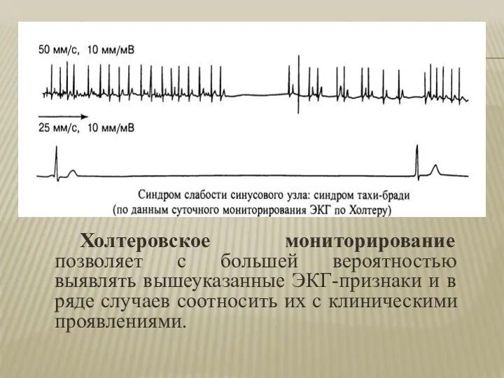 Холтеровское мониторирование позволяет с большей вероятностью выявлять вышеуказанные ЭКГ-признаки и