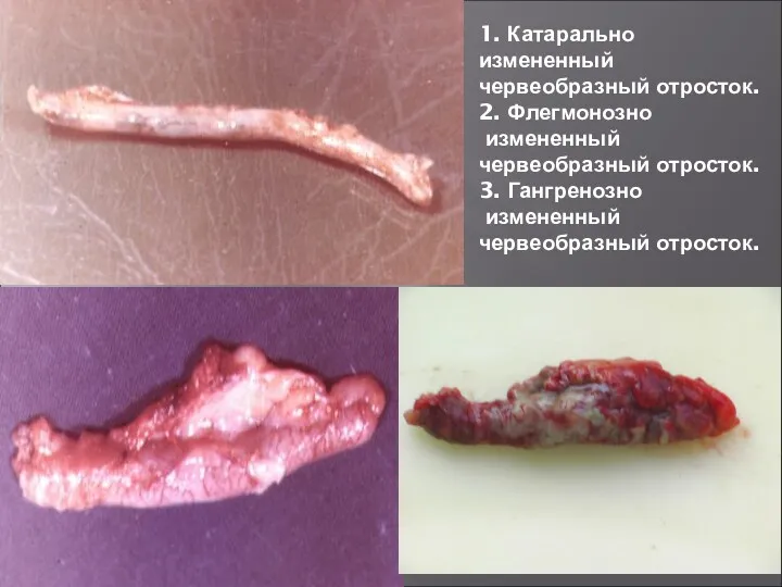 1. Катарально измененный червеобразный отросток. 2. Флегмонозно измененный червеобразный отросток. 3. Гангренозно измененный червеобразный отросток.