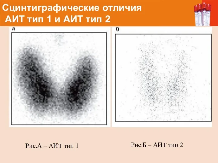 Сцинтиграфические отличия АИТ тип 1 и АИТ тип 2 Рис.Б