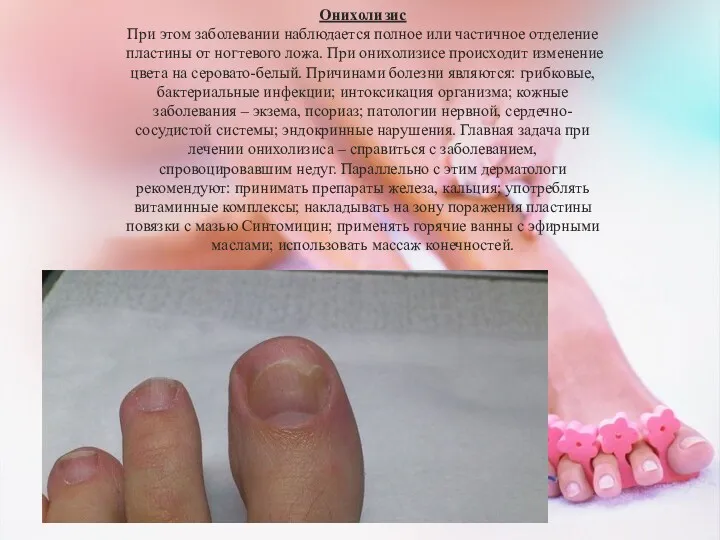 Онихолизис При этом заболевании наблюдается полное или частичное отделение пластины от ногтевого ложа.