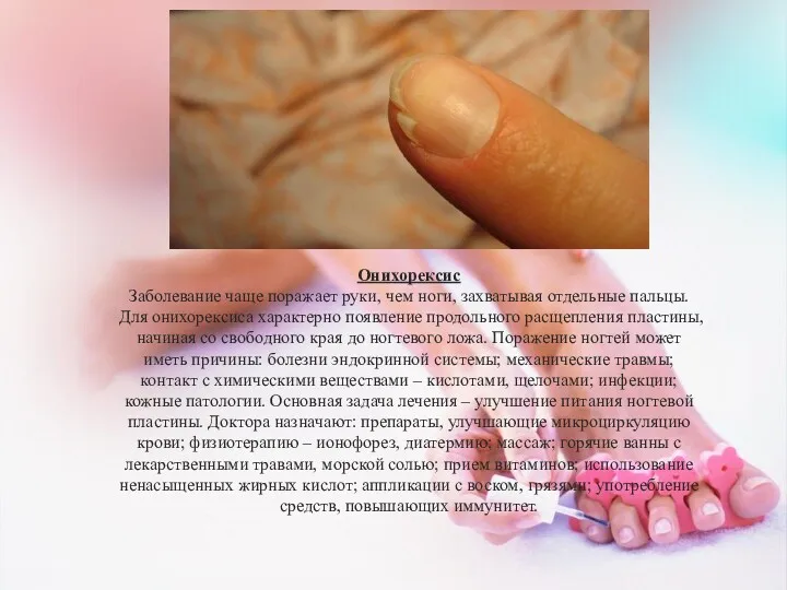 Онихорексис Заболевание чаще поражает руки, чем ноги, захватывая отдельные пальцы. Для онихорексиса характерно