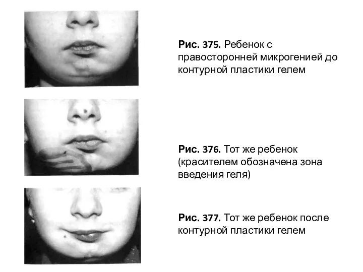 Рис. 376. Тот же ребенок (красителем обозначена зона введения геля)