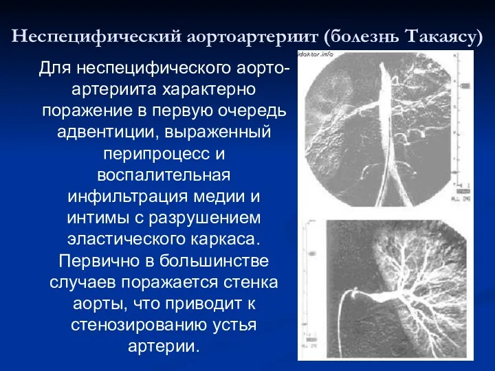 Неспецифический аортоартериит (болезнь Такаясу) Для неспецифического аорто-артериита характерно поражение в