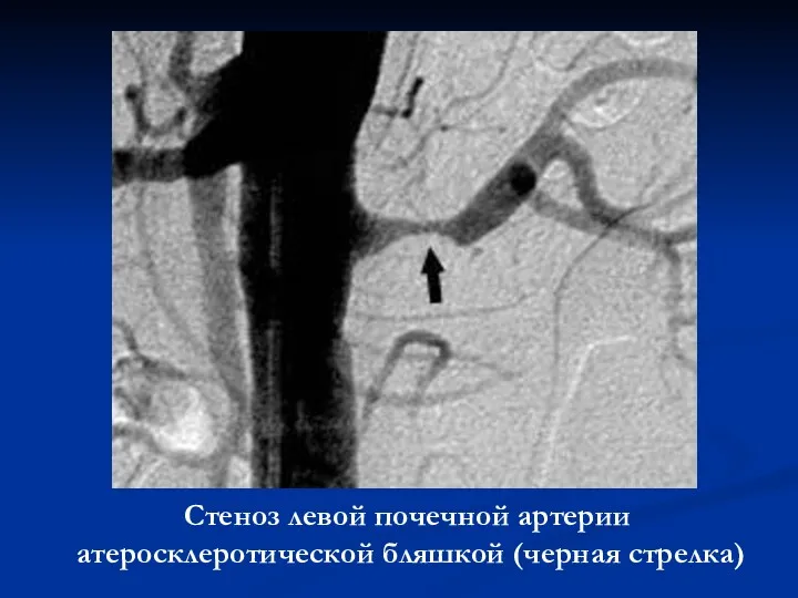 Стеноз левой почечной артерии атеросклеротической бляшкой (черная стрелка)