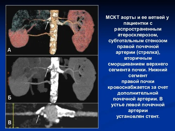 МСКТ аорты и ее ветвей у пациентки с распространенным атеросклерозом,