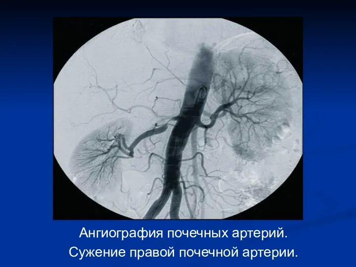 Ангиография почечных артерий. Сужение правой почечной артерии.