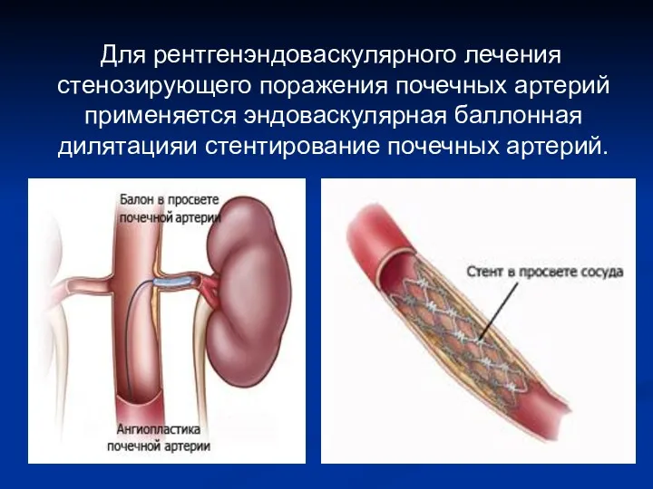 Для рентгенэндоваскулярного лечения стенозирующего поражения почечных артерий применяется эндоваскулярная баллонная дилятацияи стентирование почечных артерий.