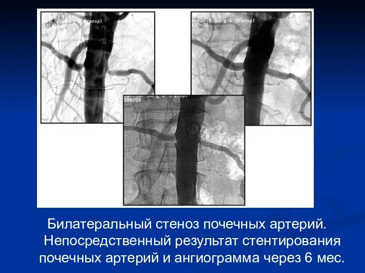 Билатеральный стеноз почечных артерий. Непосредственный результат стентирования почечных артерий и ангиограмма через 6 мес.